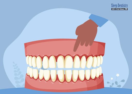 How to Fix Receding Gums: Prevention and Treatments